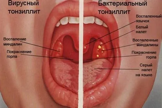 Как да се лекува ангина при 2-годишно дете