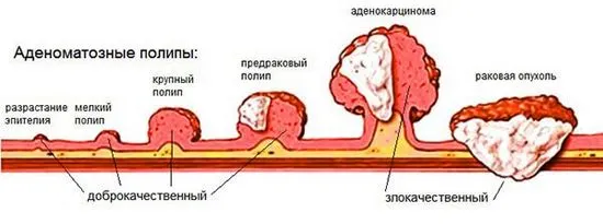 Открити са полипи в ректума