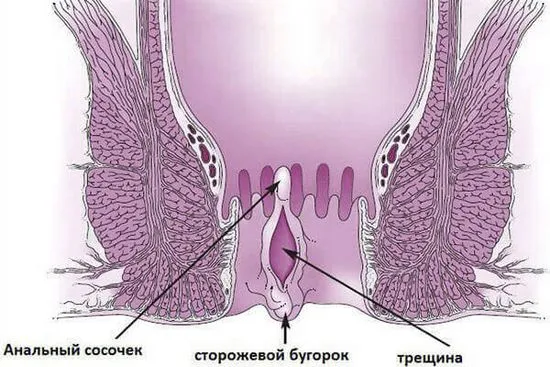 фисура