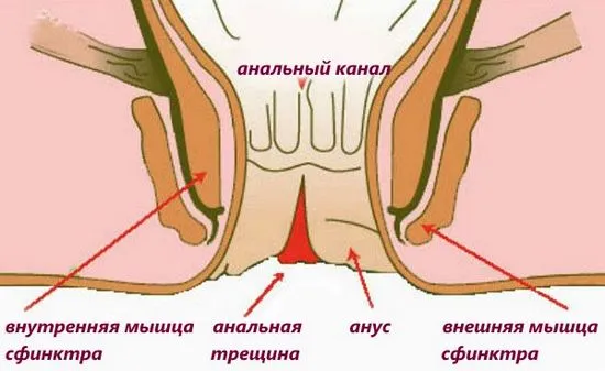 Анална фисура причини, симптоми, методи на лечение