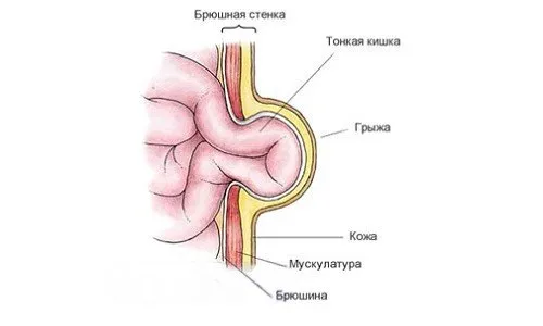Отстраняване на пъпна херния при възрастни, симптоми и причини за патология, възможни усложнения (снимка и видео)