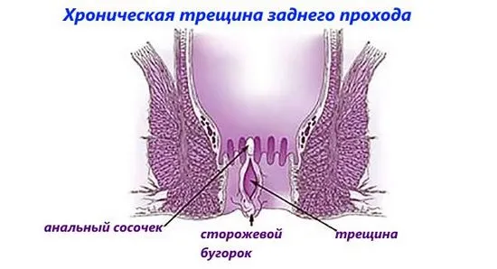 Диагностика и лечение на рак на ректума