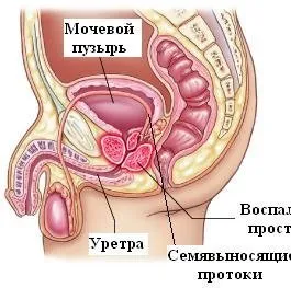 Простатит причини, симптоми и лечение