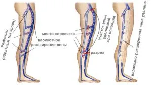 Операция за отстраняване на разширени вени - какви видове операции има