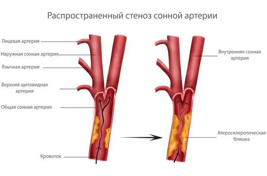 Атеросклероза на брахиоцефалните артерии - симптоми, лечение, рискови фактори