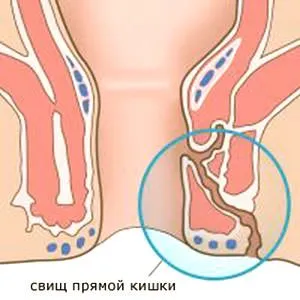 Лечение на парапроктит с ректални супозитории