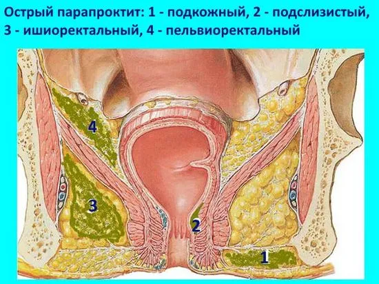 Нехирургични методи за лечение на парапроктит