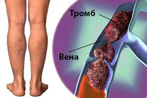 Тромбоза на подколенната вена симптоми, диагностика, лечение