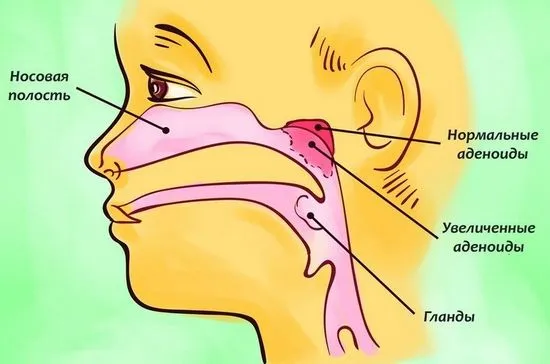 Увеличени аденоиди при дете причини, симптоми, лечение