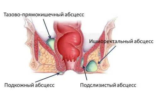 Профилактика и лечение на парапроктит след операция