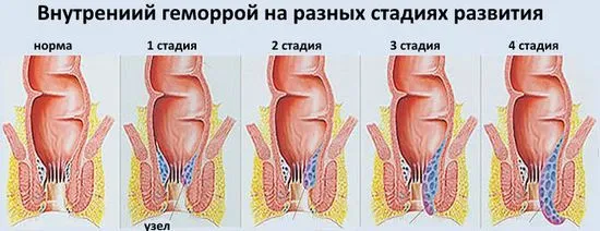 Признаци и лечение на хемороиди от 1-ва степен