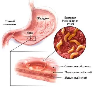 Стомашна язва причини, симптоми, признаци, лечение на болка