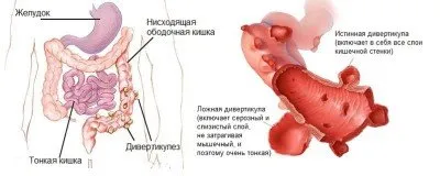 Дивертикулоза на сигмоидното дебело черво, симптоми, лечение