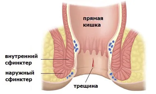 Операция за отстраняване на анална фисура