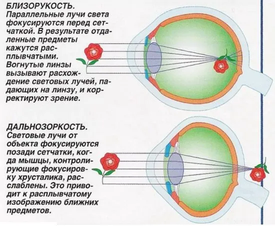 Лечение на миопия при деца в училищна възраст