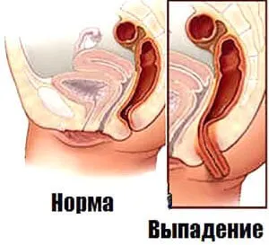 Какво да направите, ако ректумът не стои на мястото си