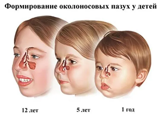 Синузит при дете, симптоми и лечение