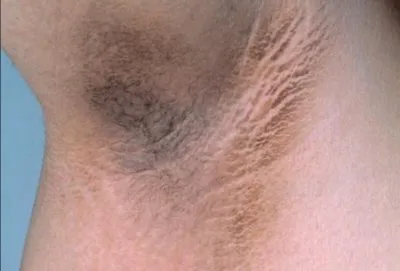 Какво представлява acanthosis nigricans при хората?