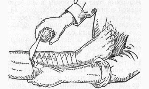 Защо да превързвате краката преди операция