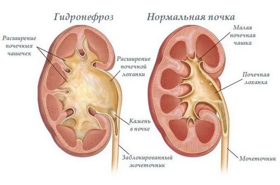 Хидронефроза - причини, симптоми, лечение, диагностика