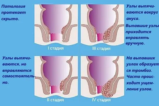 Как да определите развитието на хемороиди от 4-та степен със снимка