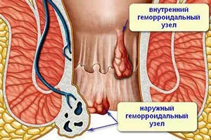 Какво да направите, ако хемороидите се появят след раждането