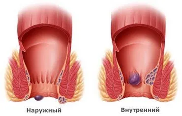 Външни хемороиди - симптоми и лечение