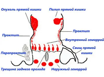 възпаление