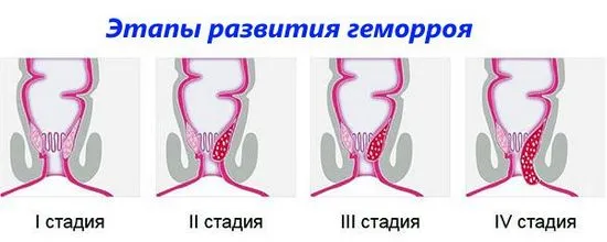 Как изглеждат хемороидните подутини на снимката