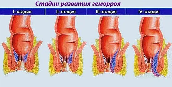 хемороиди