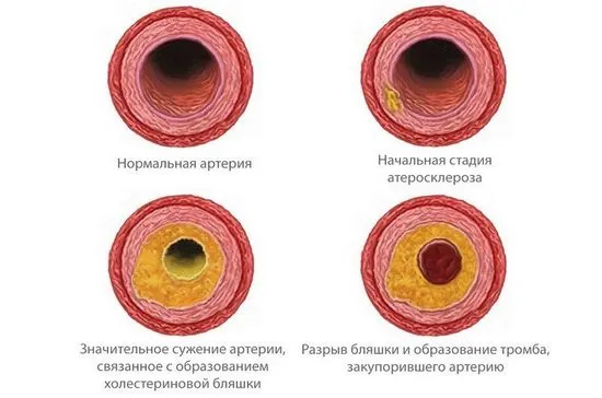 Холестеролни плаки - рискови фактори, лечение, профилактика