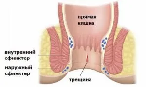 Причини за ректална фисура, симптоми, лечение - ректални супозитории, народни методи, хирургия