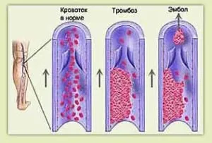 тромбоза