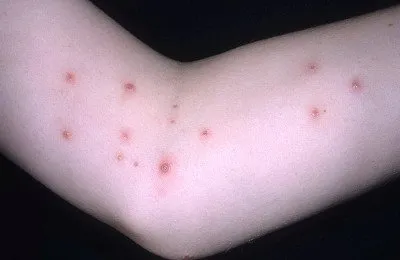 Molluscum contagiosum при деца по тялото, лицето, лечение