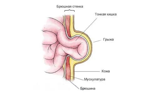 Симптоми на пъпна херния при деца