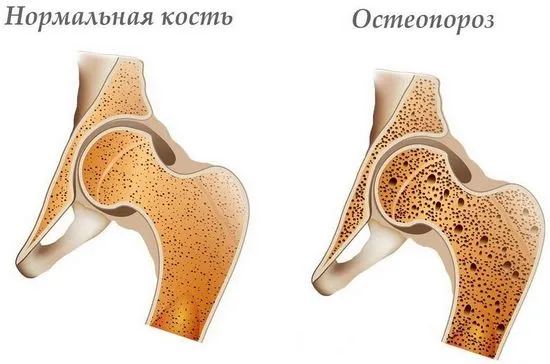 Остеопороза - причини, симптоми, методи на лечение