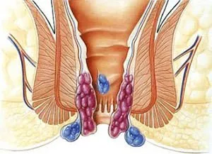 Как да се отървете от възпаление на хемороиди у дома