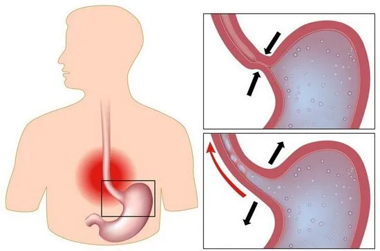 Езофагит причини, симптоми, лечение, профилактика