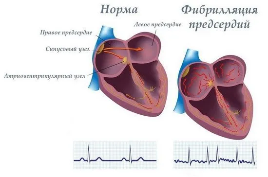 Предсърдно мъждене - причини, симптоми, методи на лечение