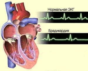 Брадикардия
