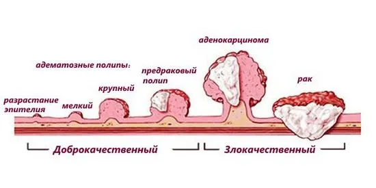 Колко хора живеят с рак на ректума