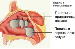 отстраняване