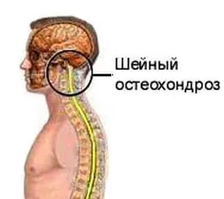 Остеохондроза на шийните прешлени симптоми, лечение, профилактика