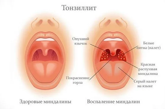 Как да се лекува тонзилит Основиметоди на лечение