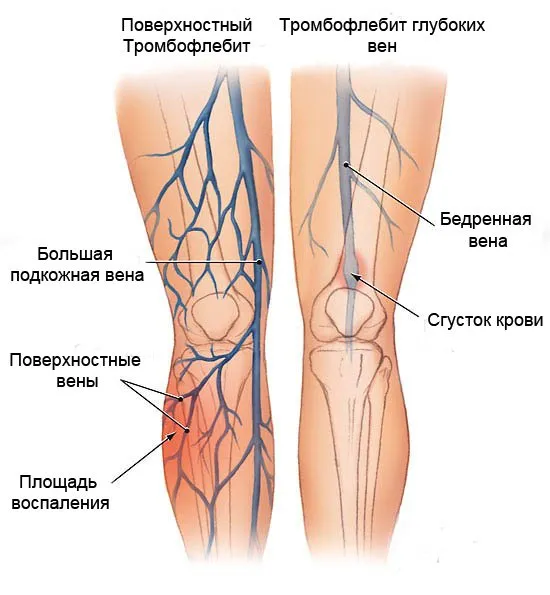 Симптоми и лечение на тромбофлебит на краката