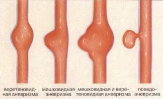 Какво е аневризма?