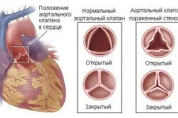 операция