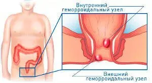 Методи за премахване на хемороиди