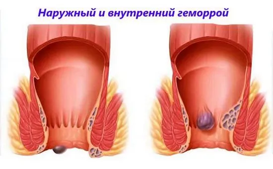 Как лесно да отървете детето от хемороиди. Причини, симптоми, лечение на хемороиди при деца