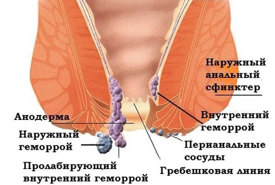 Какво да направите, ако хемороидите са паднали